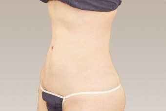 ベイザー脂肪吸引の術後症例サンプル