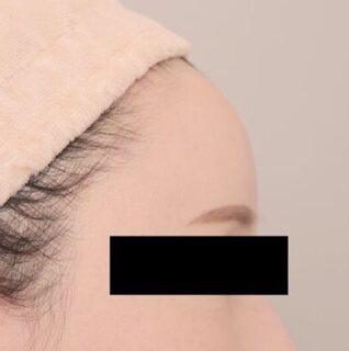 コンデンスリッチフェイス（おでこへの脂肪注入）【女性［30代前半］3ヶ月】の術後写真
