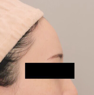 コンデンスリッチフェイス（おでこへの脂肪注入）【女性［30代前半］3ヶ月】の術前写真