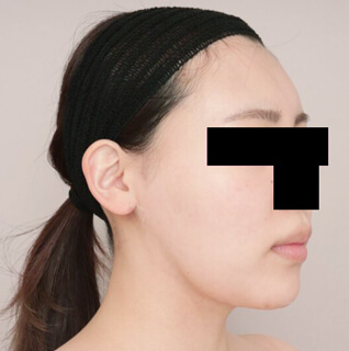 コンデンスリッチフェイス（頬のこけ）【女性/25歳 術後3日】の術後写真