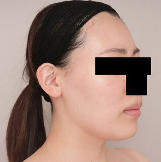 コンデンスリッチフェイス（頬のこけ）【女性/25歳 術後3日】の術前写真