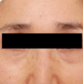 コンデンスリッチフェイス（目の下のクマ）の術前写真