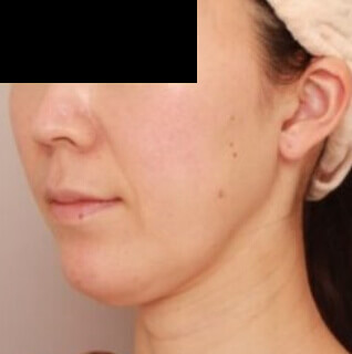 マイクロCRF注入（ほうれい線）の術前写真