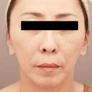 コンデンスリッチフェイス（フルフェイス）の術後写真