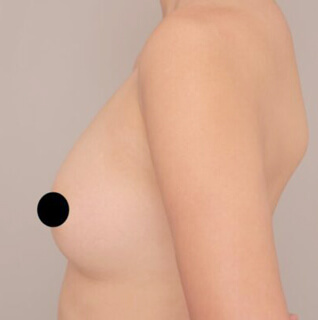 コンデンスリッチ豊胸【女性/30代後半】の術後写真