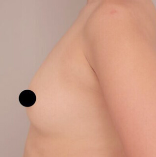 コンデンスリッチ豊胸【女性/30代後半】の術前写真