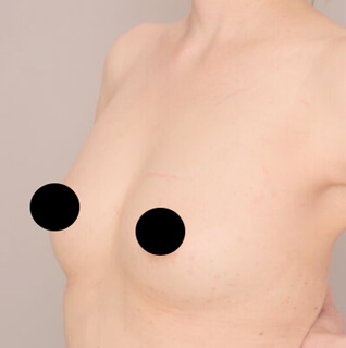 コンデンスリッチ豊胸【女性/40代後半】の術後写真