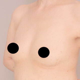 コンデンスリッチ豊胸【女性/40代後半】の術前写真