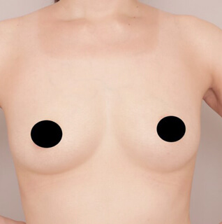 授乳後のコンデンスリッチ豊胸【女性/32歳】の術後写真