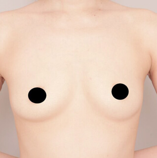 授乳後のコンデンスリッチ豊胸【女性/32歳】の術前写真