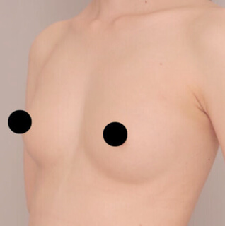 瘦せ型の方のコンデンスリッチ豊胸【女性［33歳］2ヶ月】の術後写真