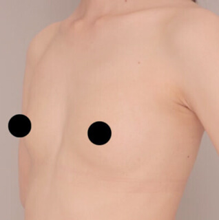 瘦せ型の方のコンデンスリッチ豊胸【女性［33歳］2ヶ月】の術前写真