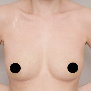 シリコンバック抜去＋コンデンスリッチ豊胸【女性/38歳】の術後写真