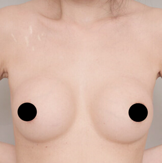 シリコンバック抜去＋コンデンスリッチ豊胸【女性/38歳】の術前写真