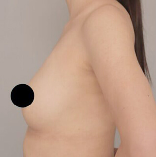 2回目のコンデンスリッチ豊胸【女性［20代］3ヶ月】の術前写真