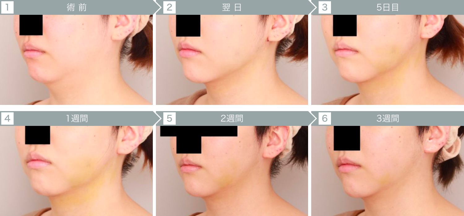 ダウンタイムの経過：顔（頬・顎下）