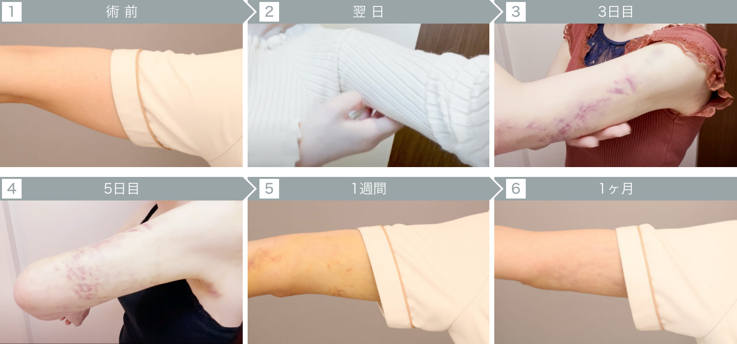 ダウンタイムの経過：二の腕