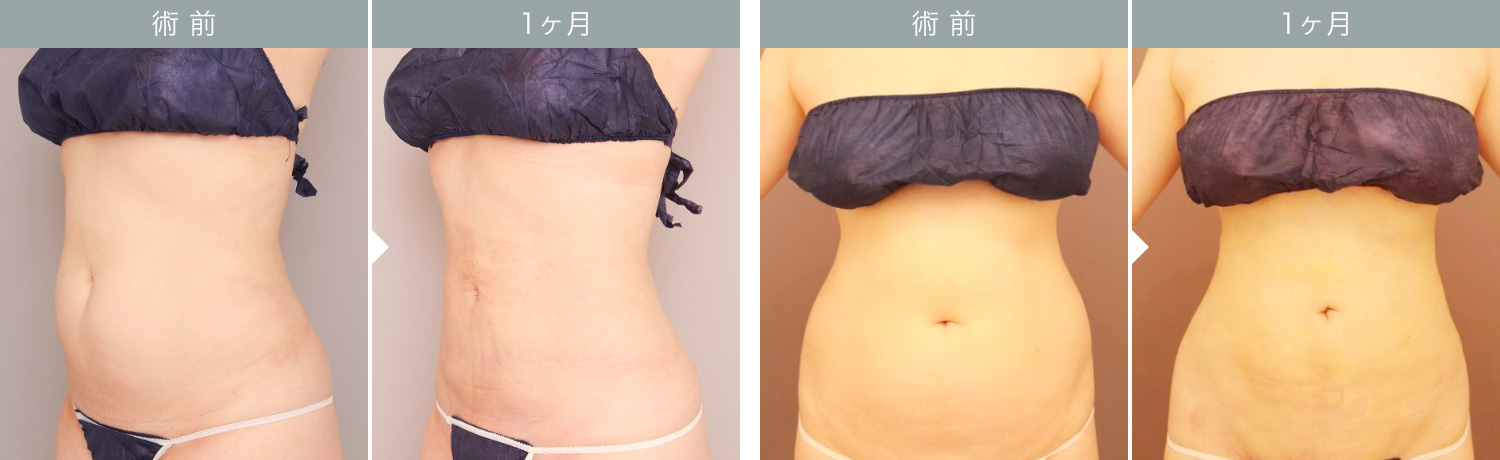 ダウンタイムの経過：腹部（お腹・腰）1ヶ月