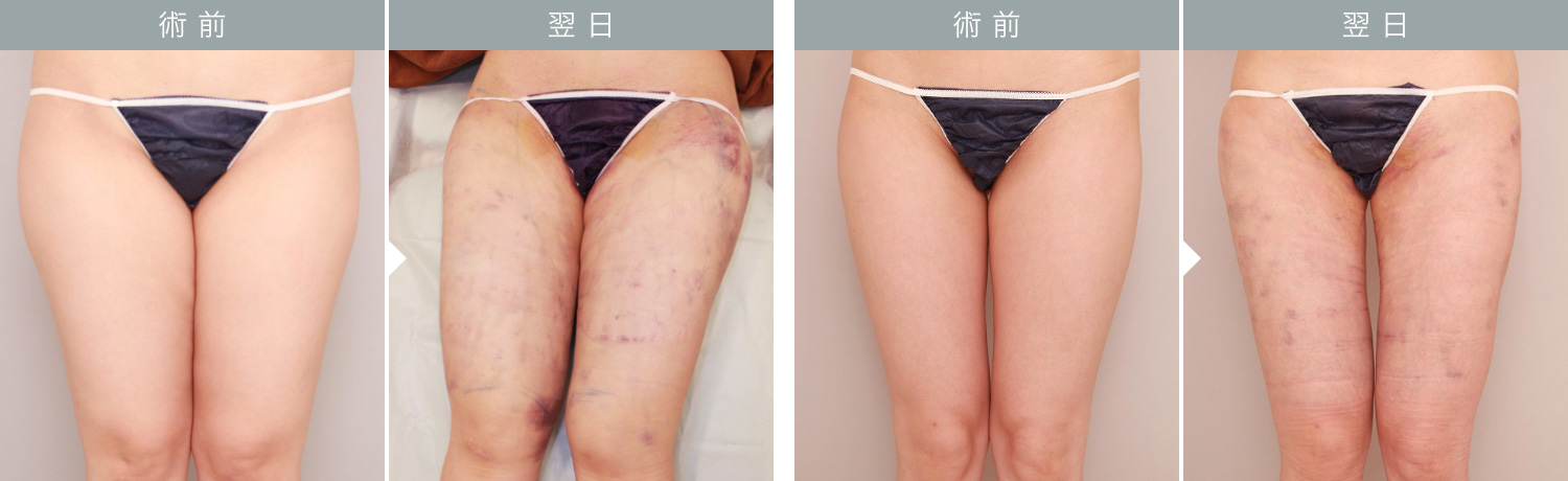 ダウンタイムの経過：太もも 翌日