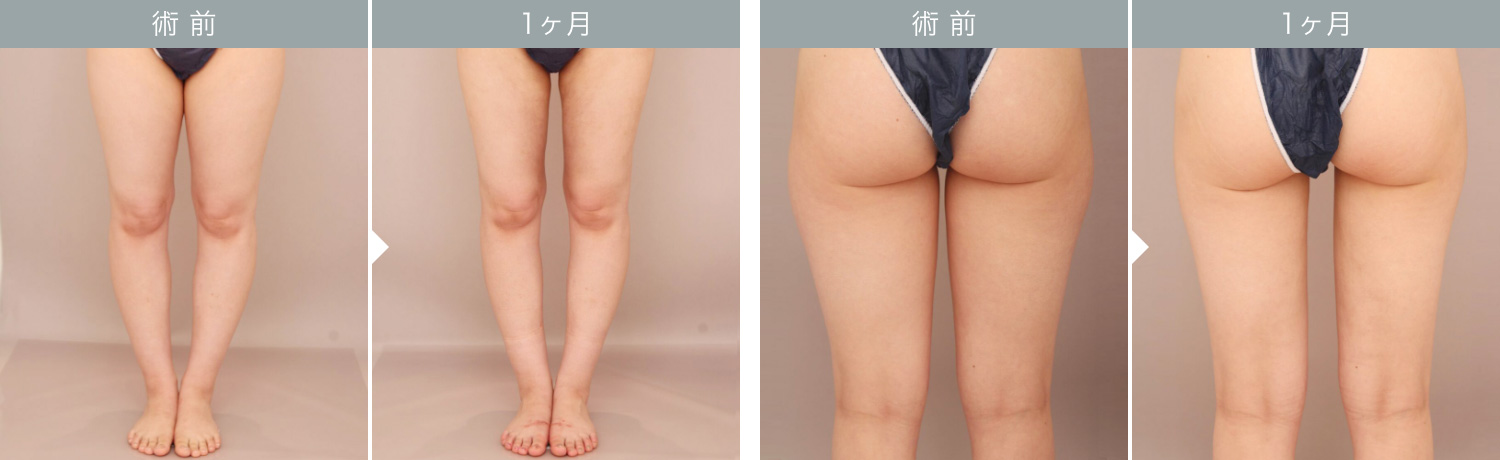 ダウンタイムの経過：太もも 1ヶ月