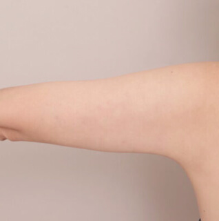 ベイザー脂肪吸引(二の腕＋肩)【女性［43歳］1ヶ月】の術後写真