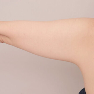 ベイザー脂肪吸引(二の腕＋肩)【女性［43歳］1ヶ月】の術前写真