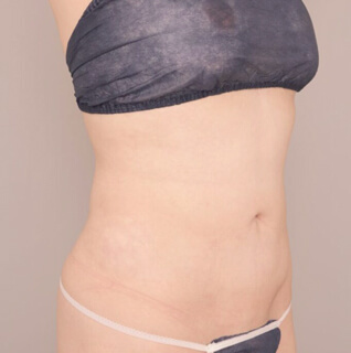 ベイザー脂肪吸引（腹部全体＋胸下＋腰）【女性［20代後半］6ヶ月】の術後写真